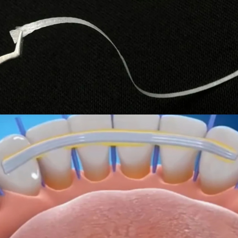 1Pcs Glass Splint Loose Tooth  - Teeth Whitening Gel Syringes review and price