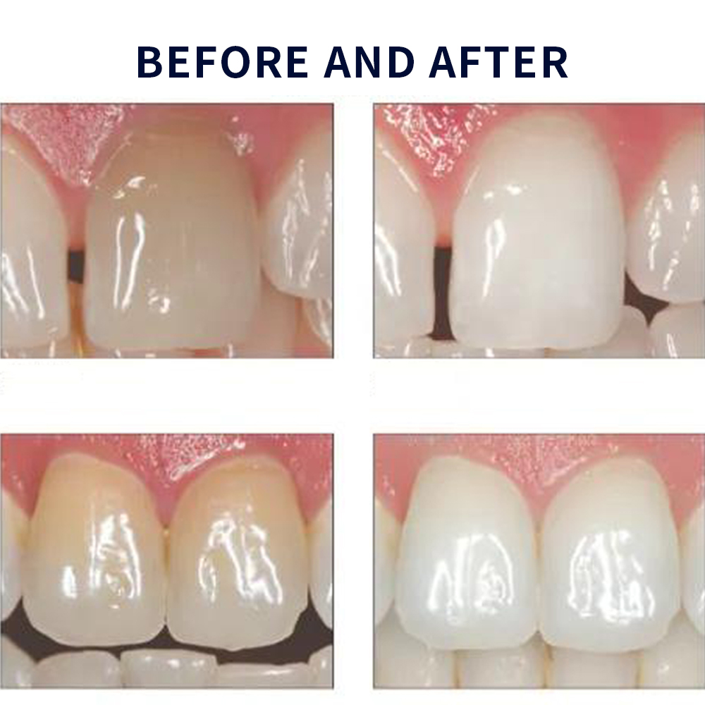 Opalescence Whitening 20% PF 2 - Teeth Whitening Gel Syringes review and price
