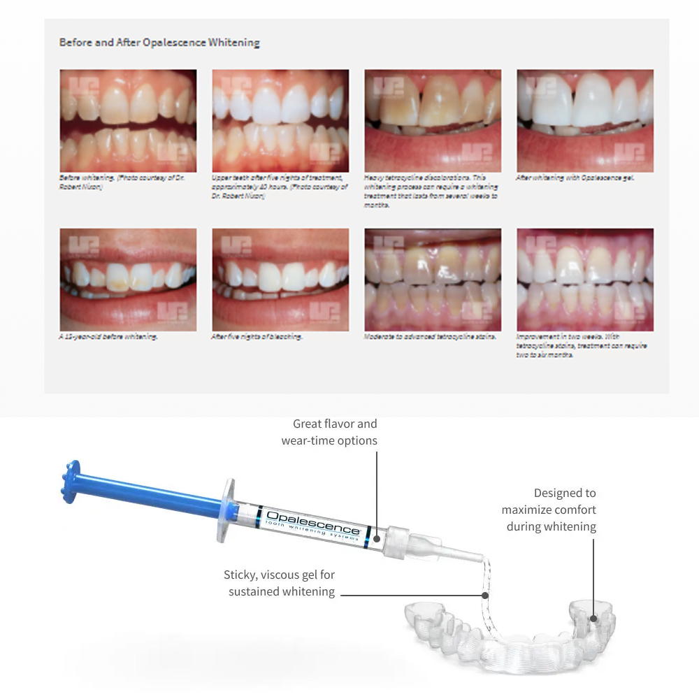 Opalescence Whitening 20% PF 2 - Teeth Whitening Gel Syringes review and price