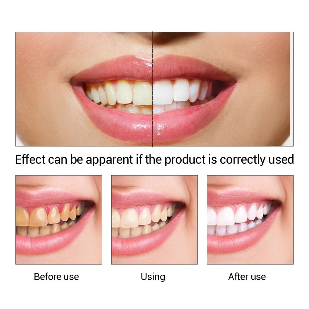 FTEENPLY Teeth Whitening Essen - Teeth Whitening Effective review and price