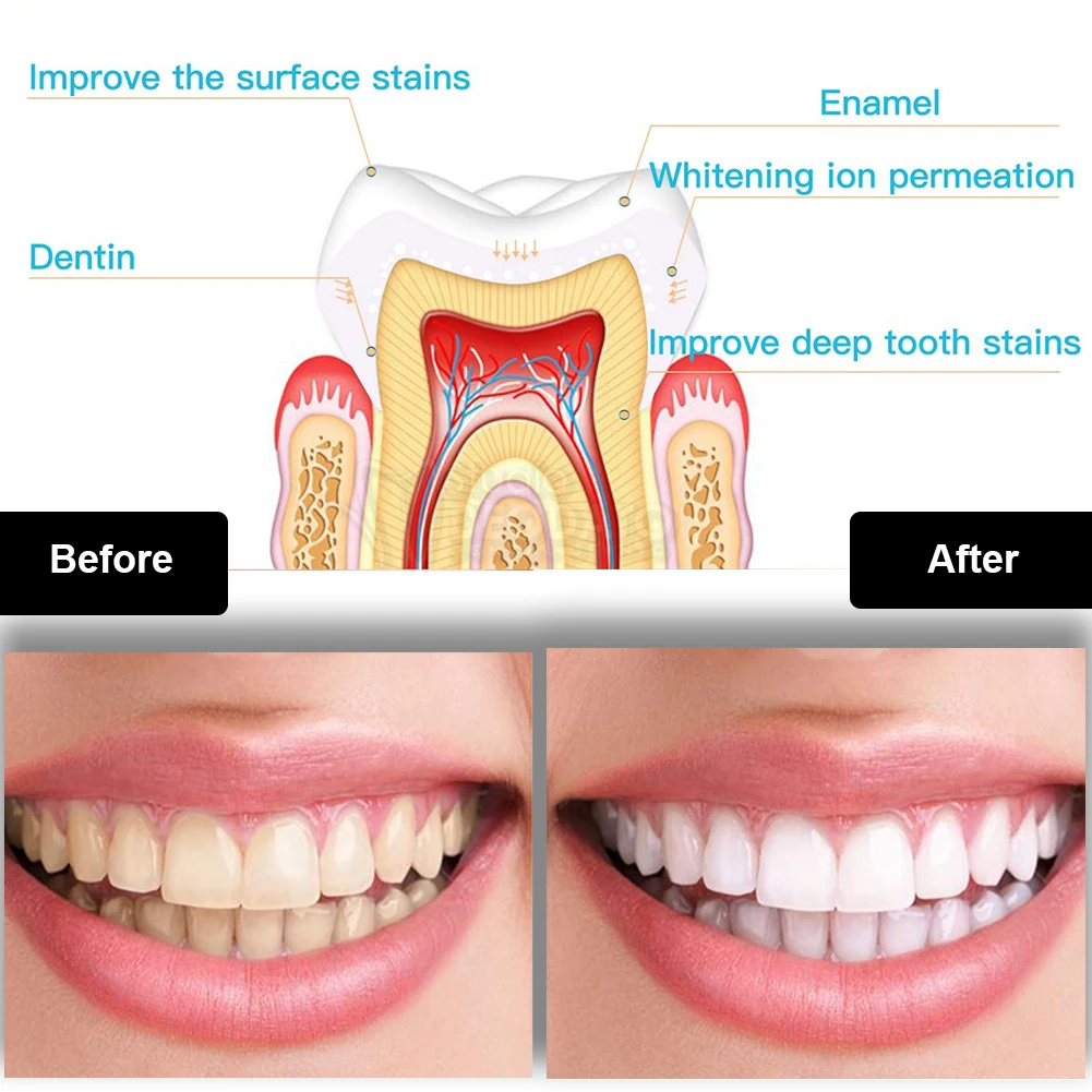 Dental Teeth Whitening Kit Min - Teeth Whitening Gel Syringes review and price