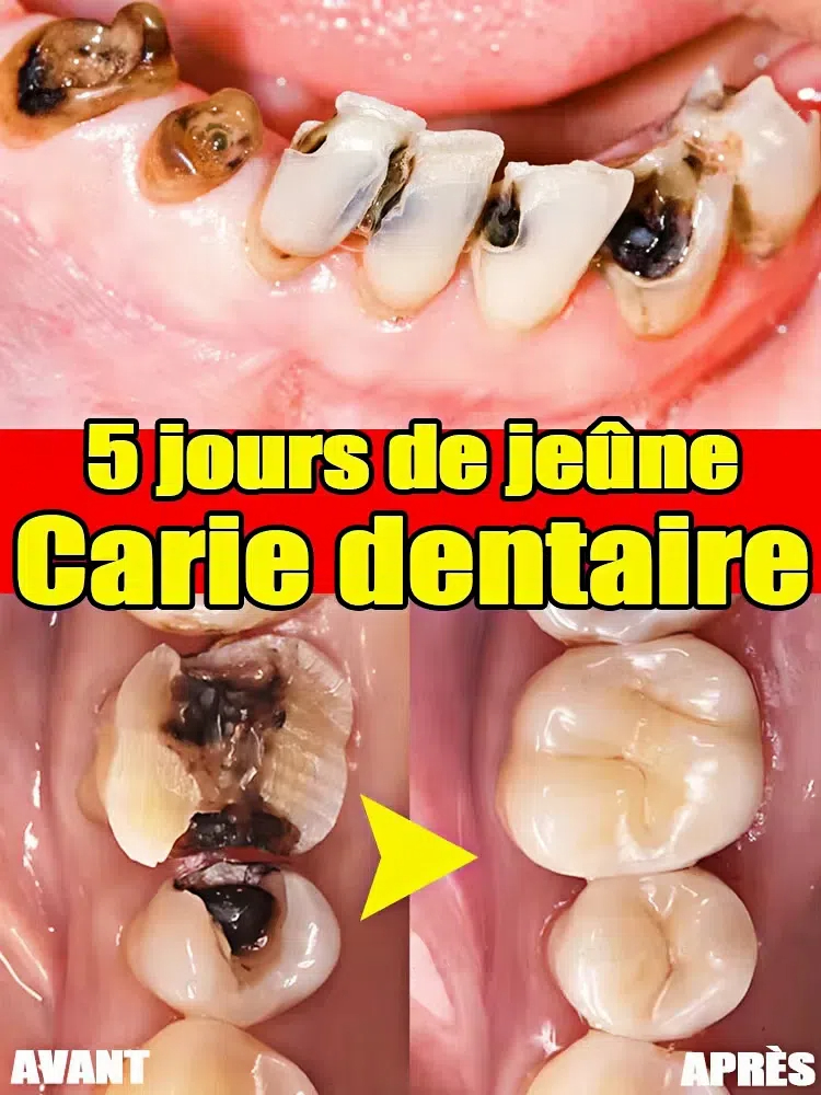 2025 Remove Cavities Effective - Teeth Whitening Effective review and price